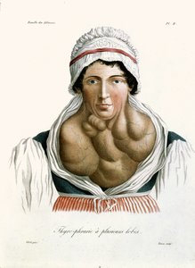 Schilddrüsenerkrankung, aus einem Buch von Baron Jean Louis Alibert (1768-1837) 1817 von French School
