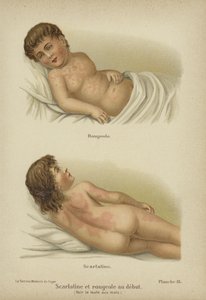 Frühe Symptome von Masern und Scharlach von German School