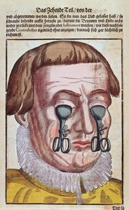 Behandlung einer Augenkrankheit, aus Ophthalmodouleia von Georg Bartisch (1535-1636) veröffentlicht in Dresden 1583 (Farbholzschnitt)