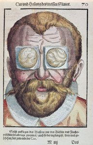 Behandlung einer Augenkrankheit, aus Ophthalmodouleia von Georg Bartisch (1535-1636) veröffentlicht in Dresden 1583 (Farbholzschnitt) von German School