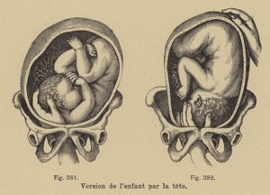 Drehen eines Babys im Mutterleib, sodass der Kopf vor der Geburt nach unten zeigt von German School
