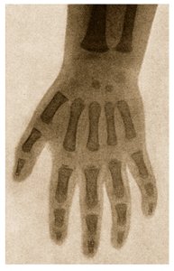 Röntgenaufnahme einer Kinderhand