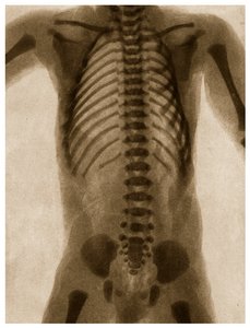Röntgenaufnahme eines menschlichen Torsos