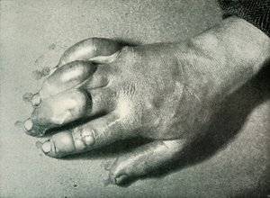 Dr. Atkinsons erfrorene Hand, 5. Juli 1911 von Herbert Ponting