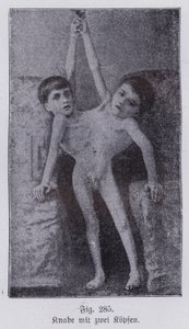 Giacomo und Giovanni Battista Tocci, italienische siamesische Zwillinge (s/w Foto)