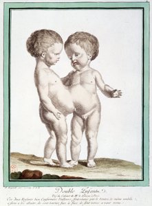 Siamesische Kinder - in „Les deviations de la nature“ von Régnault