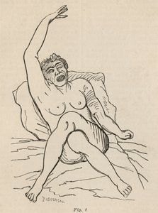 Hysterische Epilepsie, Anfall, Verrenkungen, Abb. 1 aus 