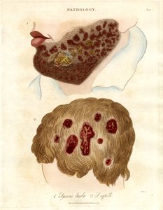 Pathologische Illustration von Sycosis barbae und Sycosis capilli