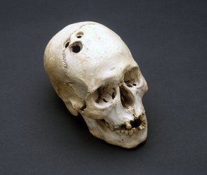 Trepanation Bronzezeitlicher Schädel, Jericho, Palästina, 2200-2000 v. Chr.
