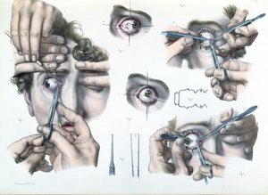 Operation an einem Strabismus, Platte aus 