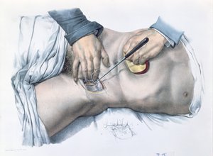 Abbindung einer Arterie, Platte aus 