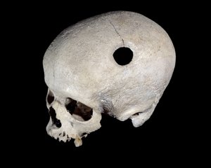 Prähistorischer Schädel mit Trepanationsspur, Museum für Nationalantiquitäten