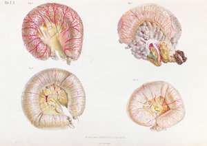 Die äußere Oberfläche der mit Cholera infizierten Eingeweide, aus Anatomie Pathologique du Cholera Morbus, von Nikolai Ivanovich Pirogov (1810-81) veröffentlicht in St. Petersburg, 1849 von Russian School