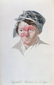 Syphilitische Clusterpusteln, aus einem Buch von Baron Jean Louis Alibert (1768-1837), 1838 von Salvadore Tresca