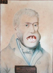 Osteosarkom des Unterkiefers, erfolgreich operiert von Guillaume Dupuytren (1777-1835) von School French