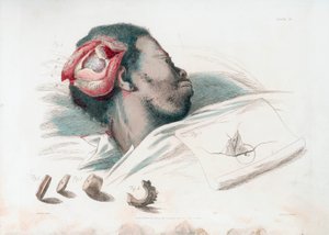 Ansicht der Wunde im Schädel nach Trepanation und Entfernung des zersplitterten Knochens unten links, 1821
