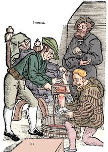 Amputation eines Beins ohne Betäubung, 1593