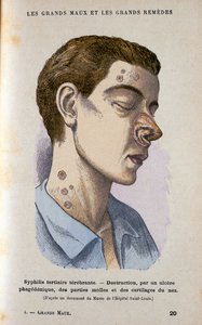 Symptome der tertiären Phase der Syphilis, 19. Jahrhundert