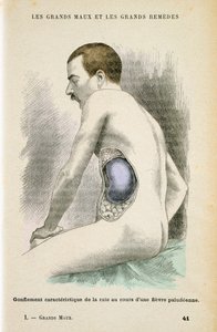 Typische vergrößerte Milz eines Malariapatienten, ca. 1890