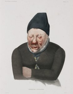 Krankheiten, Lepra