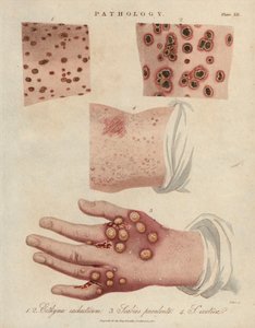 Hautgeschwür, eitrige Krätze und Krätze verursacht durch eine Sarcoptes scabiei Milbe - Lithographie von John Pass, veröffentlicht in „Encyclopedia Londinensis“ von John Wilkes, J.Adlard Ausgabe, London