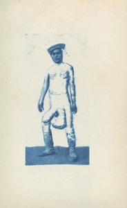 Elephantiasis von Unknown 19th Century