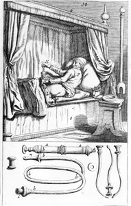 Klistier (für Einläufe) von Johannes Scultetus „Armamentarium Chirurgicum“. Venedig 1665