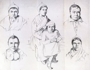 Überlegungen zu den Ursachen des endemischen Kretinismus von Morel. von Unknown artist