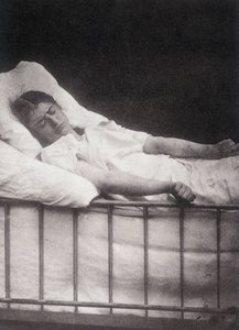 Hystero-Epilepsie - Tetanismus-Anfall in „Photographische Ikonographie der Salpêtrière: Dienst von Herrn Charcot“ von Paul Regnard und Bourneville