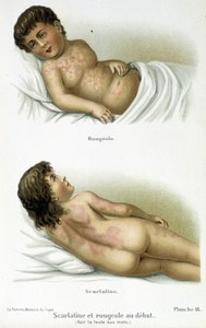 Scharlachfieber und Masern - 19. Jahrhundert von Unknown artist