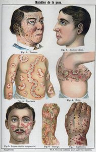 Hautkrankheiten: Ekzeme, Lippenherpes, Psoriasis, Gürtelrose, Lupus, Prurigo, Erythem. In „Die neue natürliche Heilung“ von F.E. Bilz.