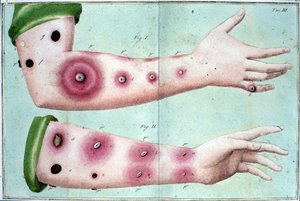 Symptome der Pockenkrankheit, die einen Ausbruch von Pusteln auf der Haut verursachen. Medizinische Tafel aus dem „Vaccination Treat“ von Luigi Sacco, Mailand