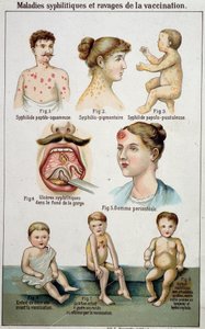 Tafel, die die verschiedenen Formen syphilitischer Krankheiten und die Gefahren der Impfung illustriert - in Bilz Naturheilkunde, Ende des 19. Jahrhunderts von Unknown artist