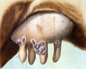 Die Brust der Kuh, die von Luigi Sacco (1769-1836) im Januar 1801 zur Pockenimpfung verwendet wurde. Medizinische Tafel aus „Vaccination Treat“ von Luigi Sacco, Mailand. von Unknown artist
