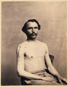 Private Adolph Zirsse, erfolgreicher Zwischenexzision des Kopfes und zweieinhalb Zoll des Schafts des rechten Humerus, aus dem fotografischen Katalog der chirurgischen Abteilung