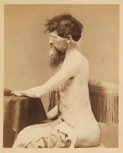 Private John Bar, Genesung nach einer Durchdringenden Bauchverletzung mit Bruch des Linken Os Innominatum, aus dem Fotografischen Katalog der Chirurgischen Abteilung