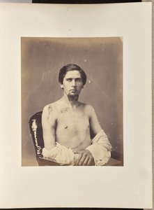 Erfolgreiche Entfernung des Kopfes des rechten Humerus von William H. Bell