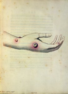 Kuhpockenpustel am Arm von Sarah Nelmes, aus 