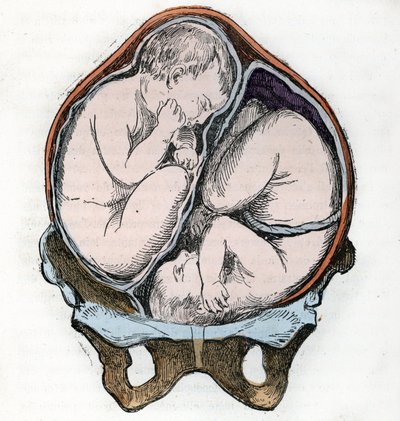 Darstellung der guten Position von zwei Föten während einer Zwillingsschwangerschaft, Gravur aus „La nature et l