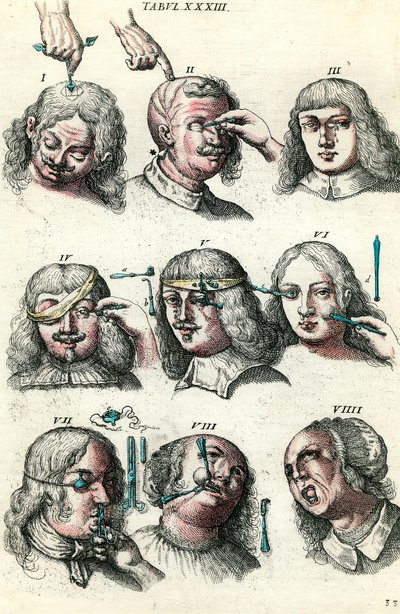 Chirurgie im 18. Jahrhundert: Trepanation und Operation von Auge und Gesicht. Gravur in „Institutionis chirurgicae“ von Lorenzo Heister von Anonymous Anonymous