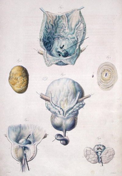 Krankheiten der Blase und Prostata, aus 