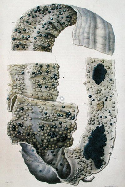 Krankheiten des Darms, aus 