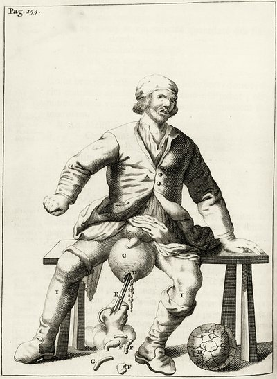 Abfluss von Flüssigkeit aus einem Hydrozele des Hodensacks, aus Exercitationes Practicae circa Medendi Methodum von Frederik Dekkers, 1694 von Dutch School