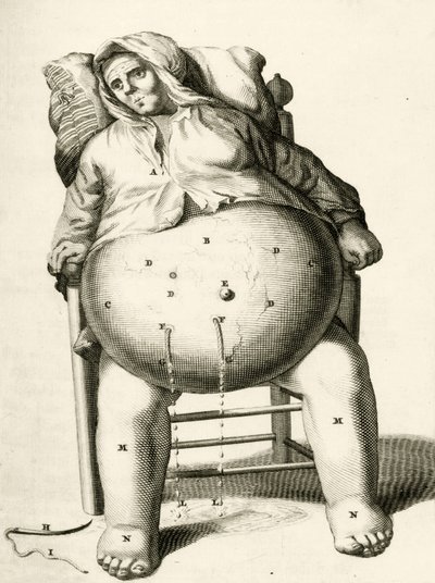 Abfluss von Flüssigkeit aus einem Abszess, aus Exercitationes Practicae circa Medendi Methodum von Frederik Dekkers, 1694 von Dutch School