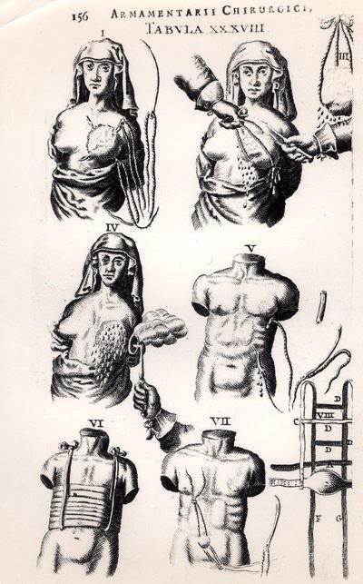 Operation bei Brustkrebs, aus Armamentarii Chirurgici von Johannes Schultes, veröffentlicht in Amsterdam, 1672 von Dutch School