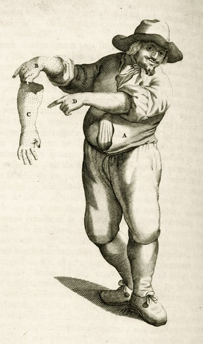 Entfernung abgestorbener Haut mit Pusteln, aus Exercitationes Practicae circa Medendi Methodum von Frederik Dekkers, 1694 von Dutch School