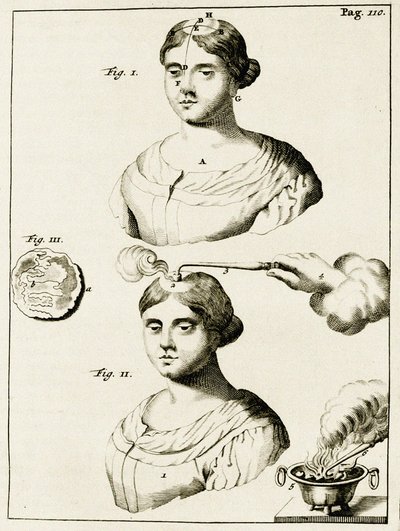 Behandlung eines Epilepsiekranken, aus Exercitationes Practicae circa Medendi Methodum von Frederik Dekkers, 1694 von Dutch School