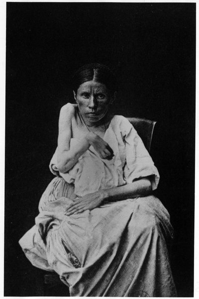 Fotografie eines Patienten mit hemiplegischer Epilepsie, in „photographische Ikonographie der Salpêtrière“, Bourneville und P. Regnard, Paris von French Photographer