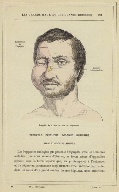 Fortschreitendes Gesichts-Erysipel von French School