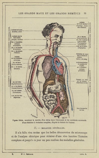 Ideale Figur, die den Verlauf eines Virus im Körper und die aufeinanderfolgenden Unfälle einer vollständigen Diathese zeigt, nach der Theorie des Autors von French School